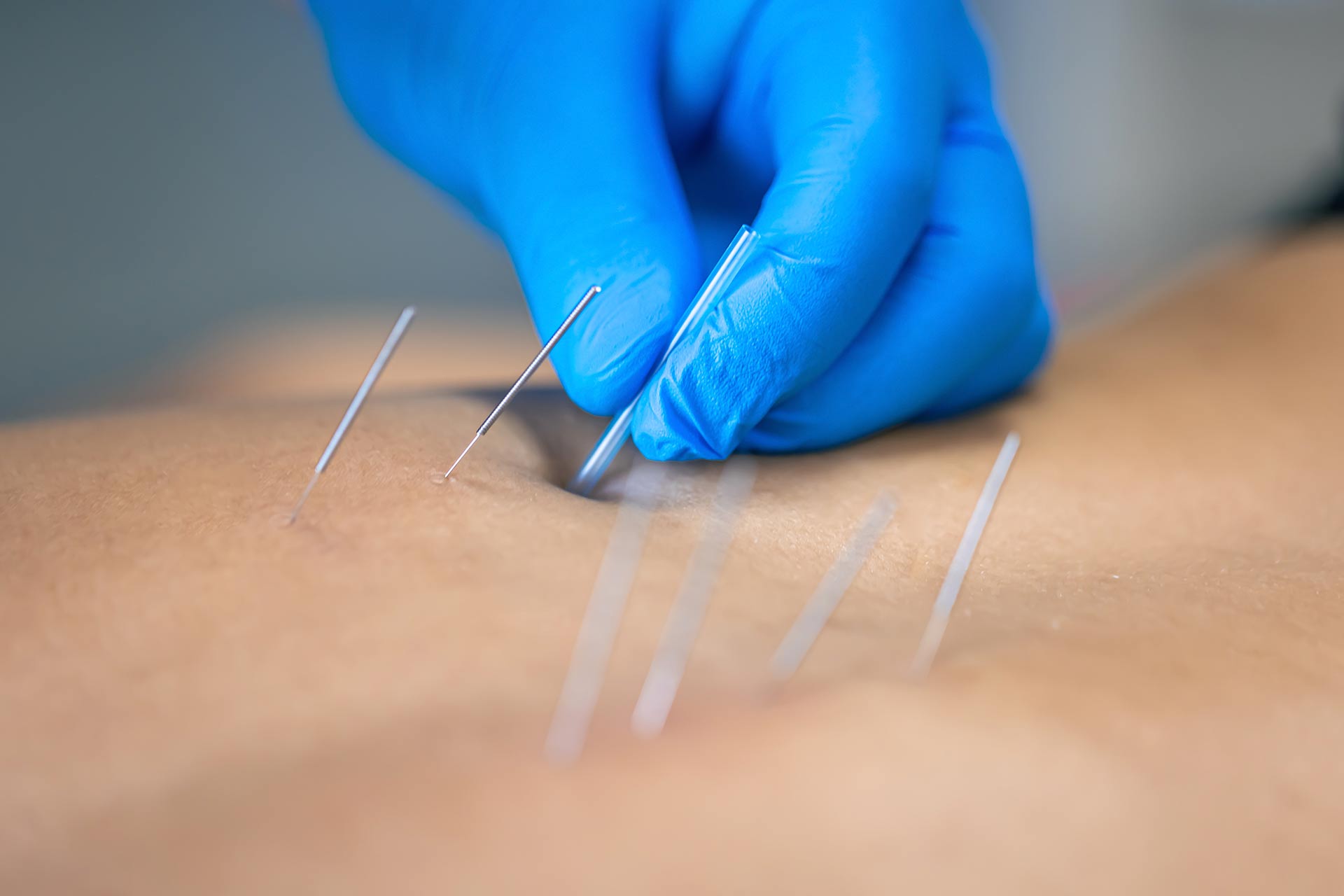 close-up-needle-hands-physiotherapist-doing-dry-needling